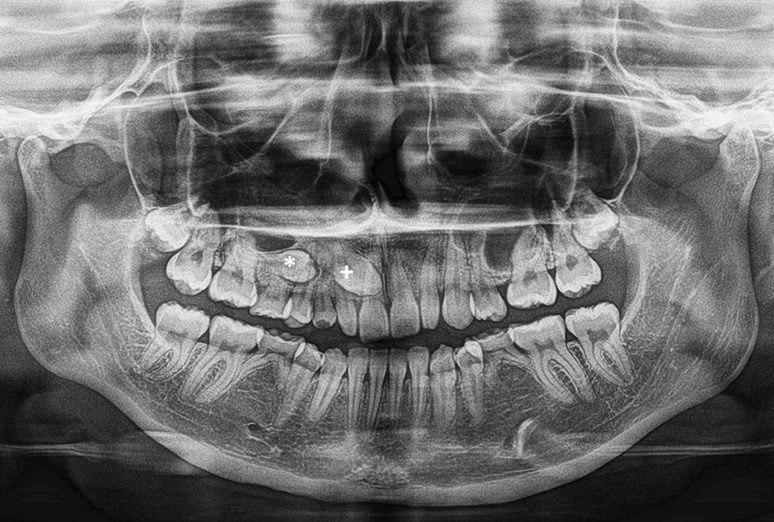 Radiografía panorámica de ambos maxilares