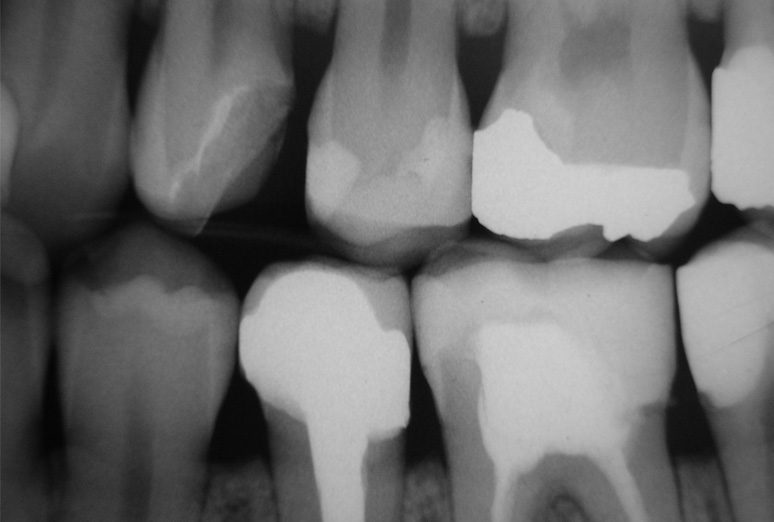 Radiografía bitewing para ver caries proximales