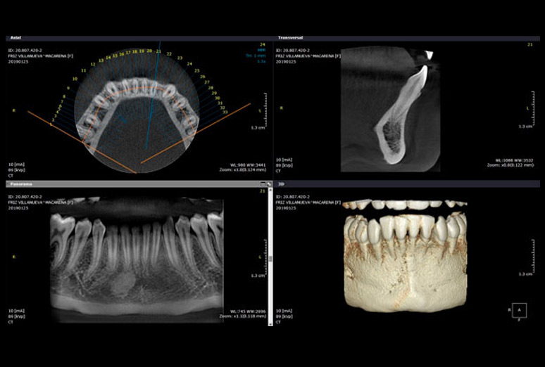 Tomografía Cone Beam de un maxilar