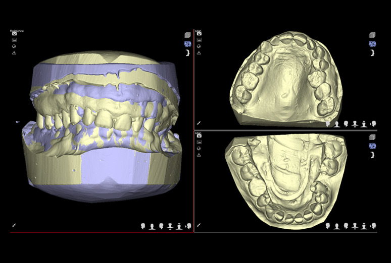 Escaneo 3D de modelos de estudio dentales