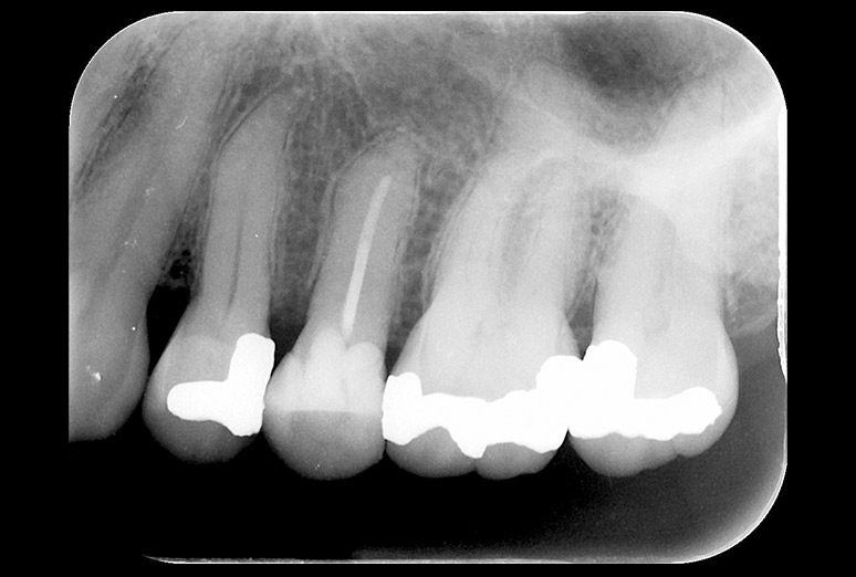 Radiografía retroalveolar de una pieza dental y su raíz