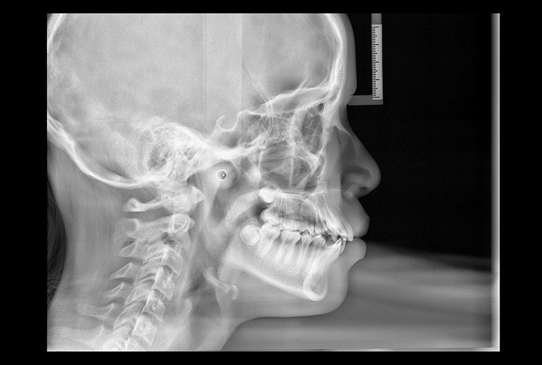 Telerradiografía lateral de cráneo